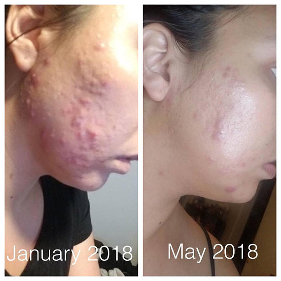 Before and after comparison of acne on a person's face, labeled with 'January 2018' and 'May 2018'. deep hydrating body butter for winter dry skin and online store. Axis-Dynamics