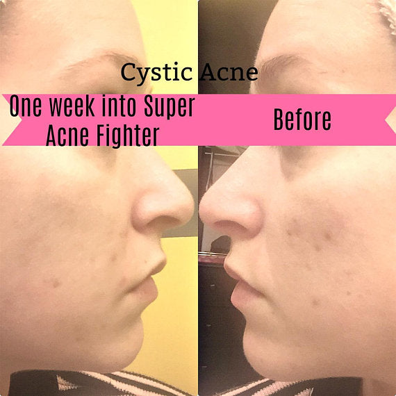 Axis-Dynamics | Super Acne Fighter / Organic Acne Treatment / Acne